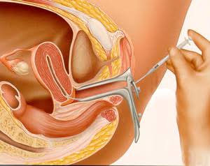 Intra-Uterine Insemination (IUI)